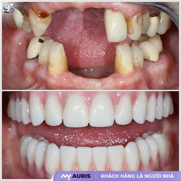 implant kuwotech,trụ implant kuwotech