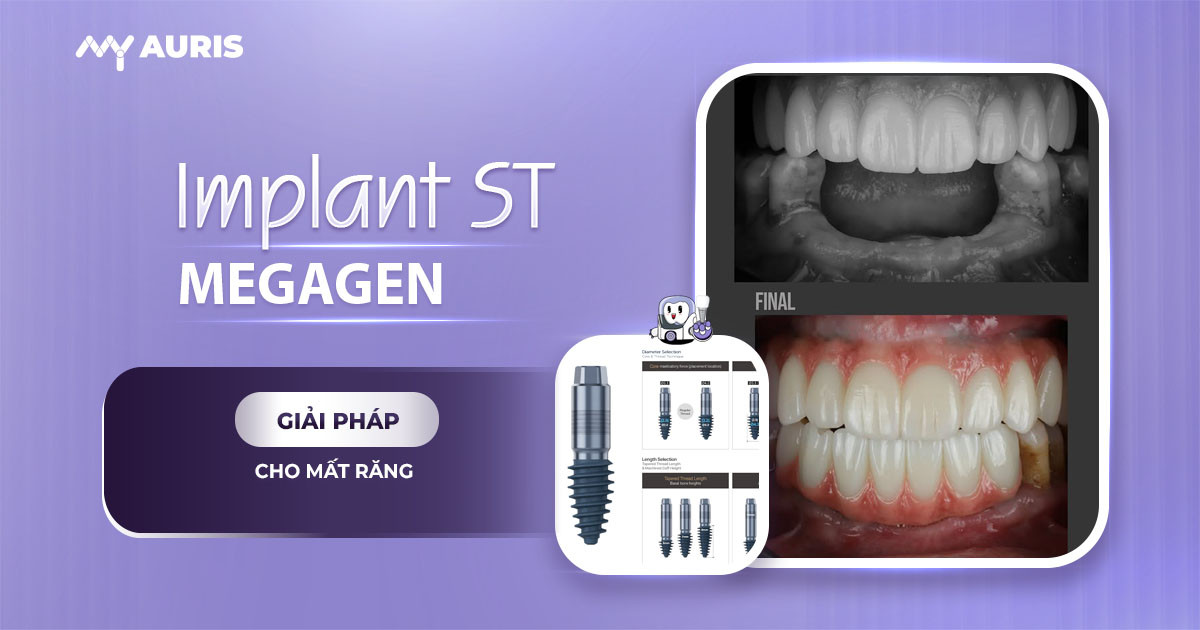 implant st,implant megagen st