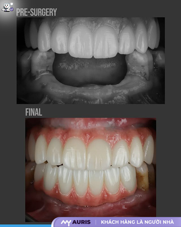 implant st,implant megagen st