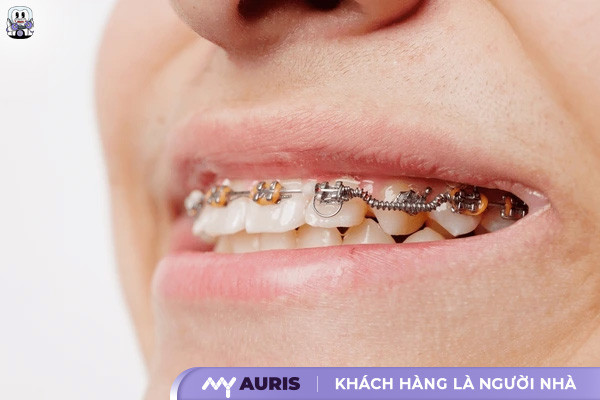 lò xo niềng răng,lò xo đẩy răng