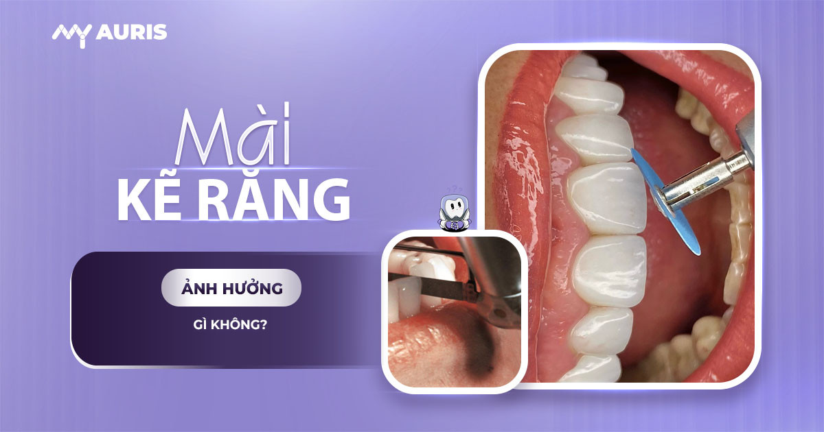 mài kẽ răng có ảnh hưởng gì không,mài răng khi niềng có ảnh hưởng gì không