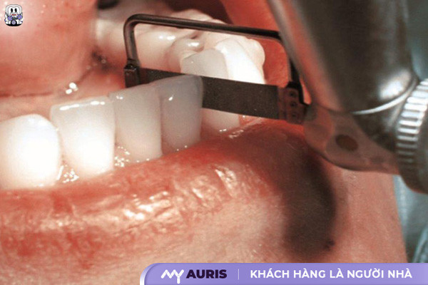 mài kẽ răng có ảnh hưởng gì không,mài răng khi niềng có ảnh hưởng gì không