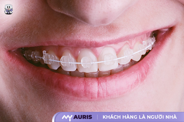 14 tuổi niềng răng bao lâu, niềng răng cho trẻ 14 tuổi