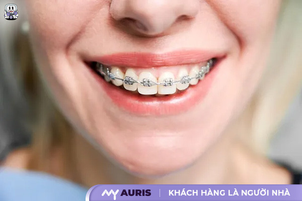 14 tuổi niềng răng bao lâu, niềng răng cho trẻ 14 tuổi