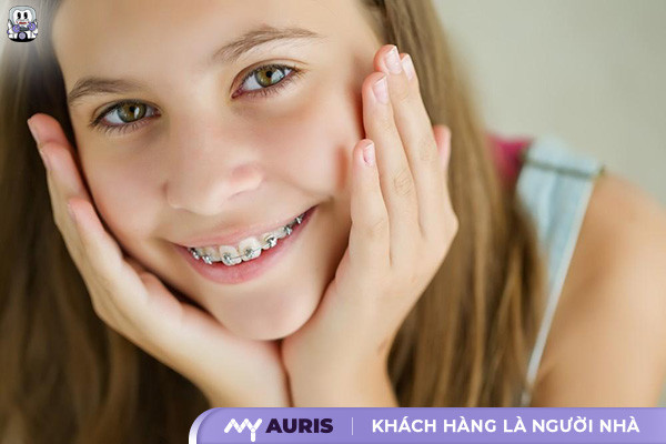 14 tuổi niềng răng bao lâu, niềng răng cho trẻ 14 tuổi