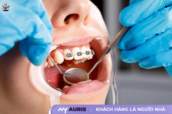14 tuổi niềng răng bao lâu, niềng răng cho trẻ 14 tuổi