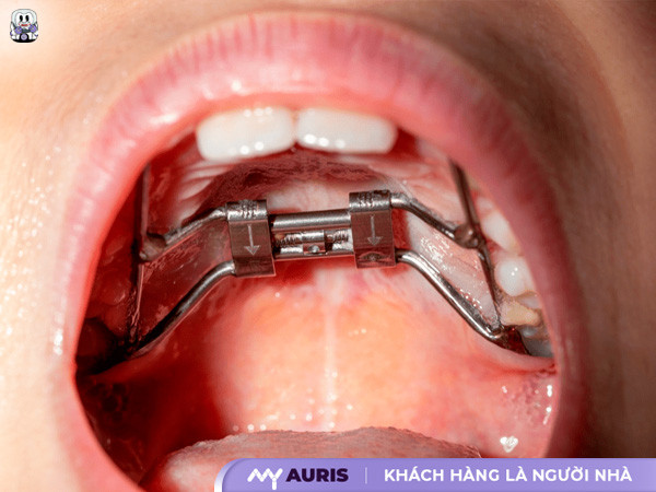 niềng răng cho bé 6 tuổi,niềng răng cho be 6 tuổi