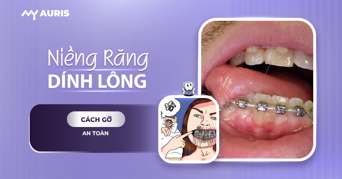 niềng răng dính lông