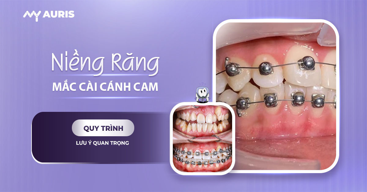 niềng răng mắc cài cánh cam