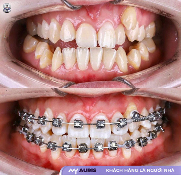 niềng răng mắc cài cánh cam