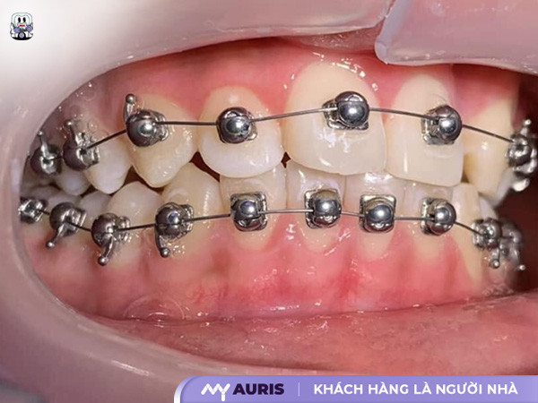 niềng răng mắc cài cánh cam