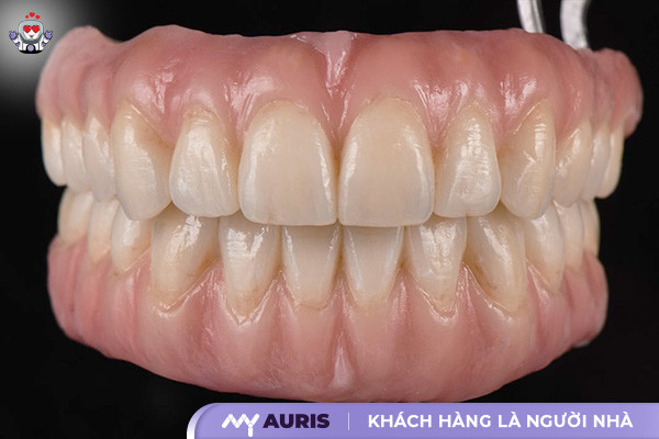 răng sứ argen, bọc răng sứ argen