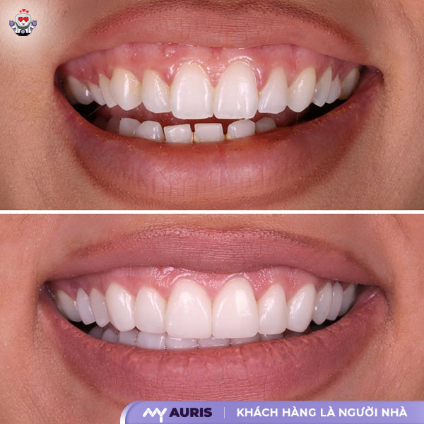 răng sứ argen, bọc răng sứ argen