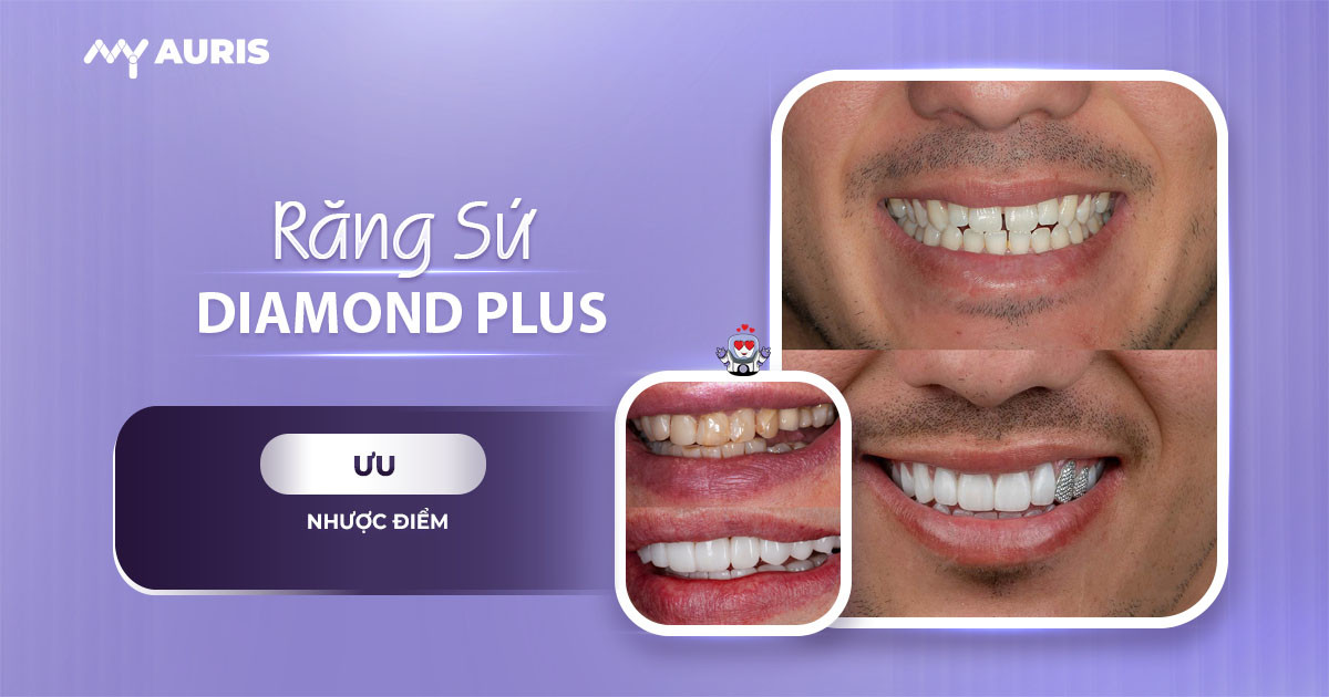 răng sứ diamond plus