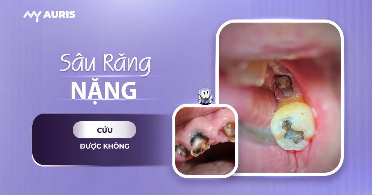 sâu răng nặng,sâu răng nhẹ