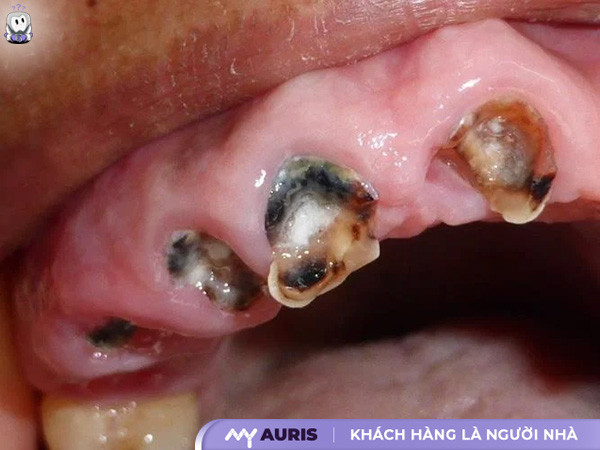 sâu răng nặng,sâu răng nhẹ