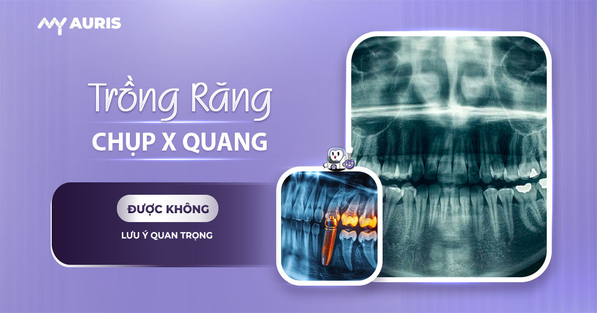 trồng răng implant có chụp x quang được không
