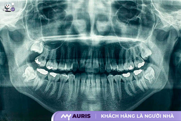 quy trình trồng răng implant chuẩn y khoa