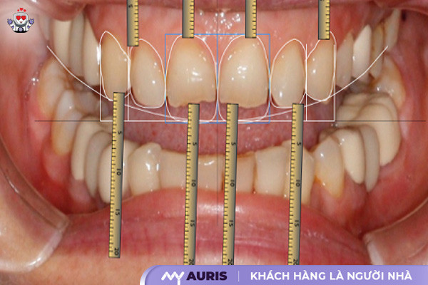 công nghệ phủ răng sứ invy ultra 3p