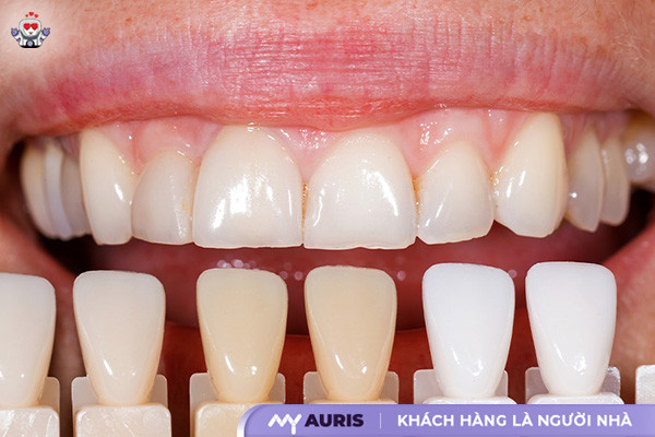 công nghệ phủ răng sứ invy ultra 3p