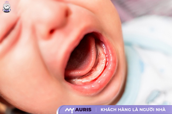 hình ảnh lợi trẻ sắp mọc răng cửa,hình ảnh lợi trẻ sắp mọc răng của,hình ảnh bé sắp mọc răng,hình ảnh lợi trẻ sắp mọc răng