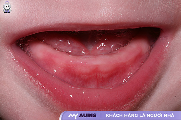 hình ảnh lợi trẻ sắp mọc răng cửa,hình ảnh lợi trẻ sắp mọc răng của,hình ảnh bé sắp mọc răng,hình ảnh lợi trẻ sắp mọc răng