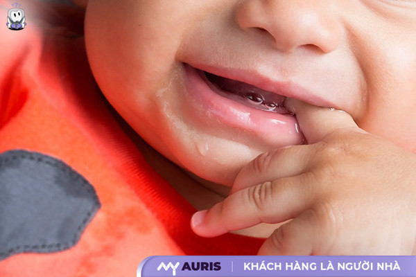 hình ảnh lợi trẻ sắp mọc răng cửa,hình ảnh lợi trẻ sắp mọc răng của,hình ảnh bé sắp mọc răng,hình ảnh lợi trẻ sắp mọc răng
