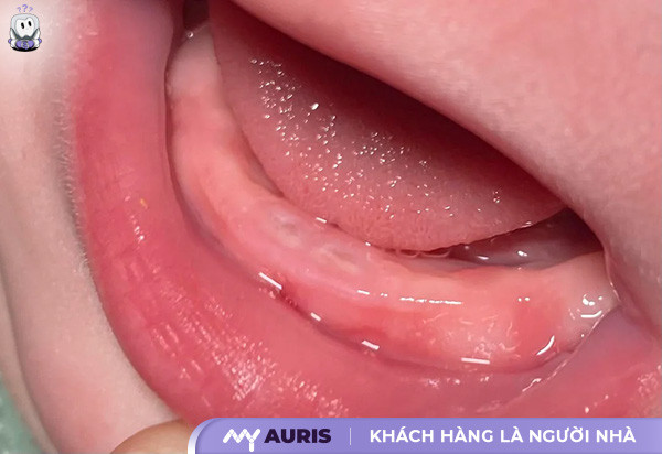 hinh-anh-tre-sap-moc-rang-030725-10
