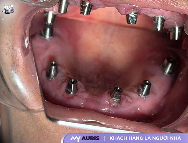 implant myq