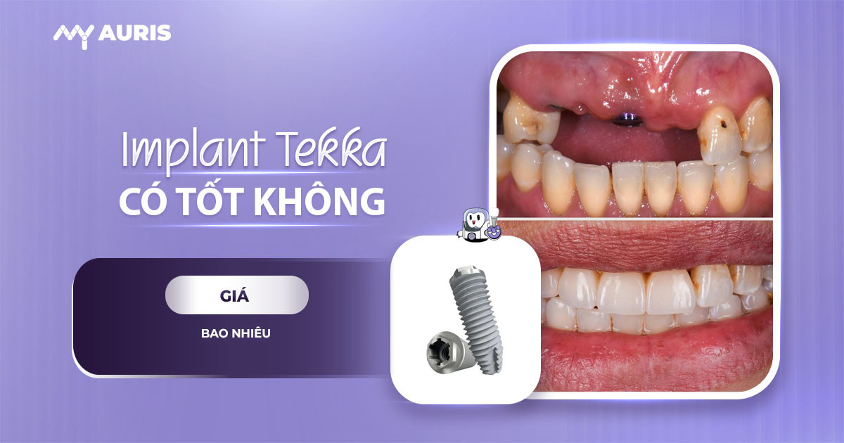 implant tekka pháp,implant tekka