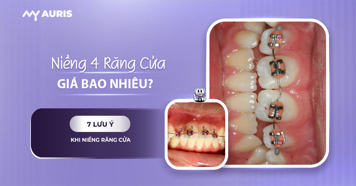niềng 4 răng cửa giá bao nhiêu