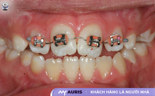 niềng 4 răng cửa giá bao nhiêu