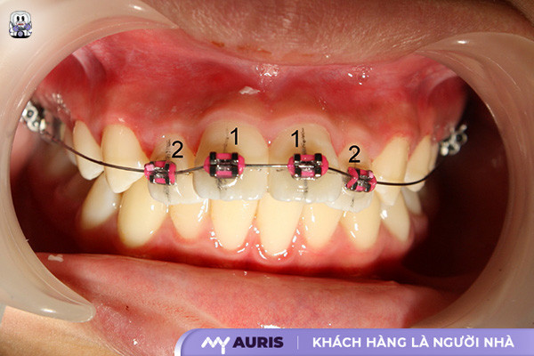 niềng 4 răng cửa giá bao nhiêu