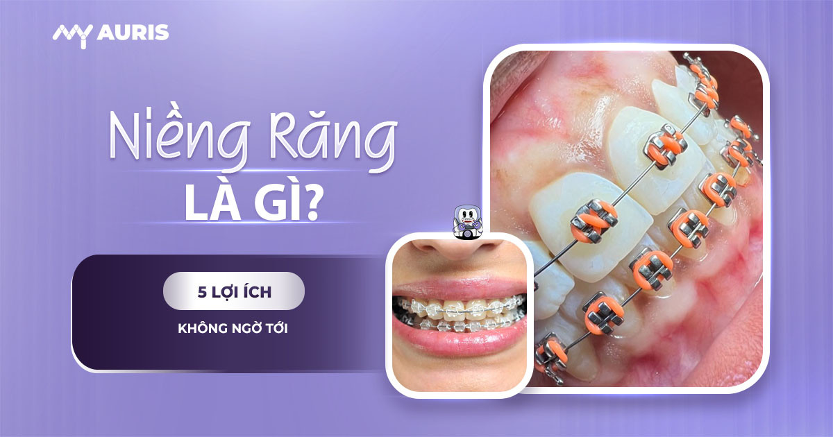 niềng răng là gì,niềng răng