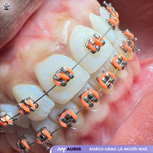 niềng răng là gì,niềng răng