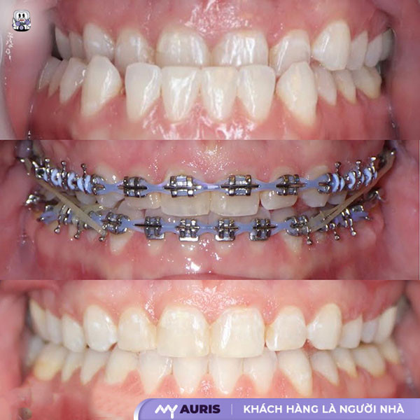 Hình ảnh trước – sau khi niềng răng móm