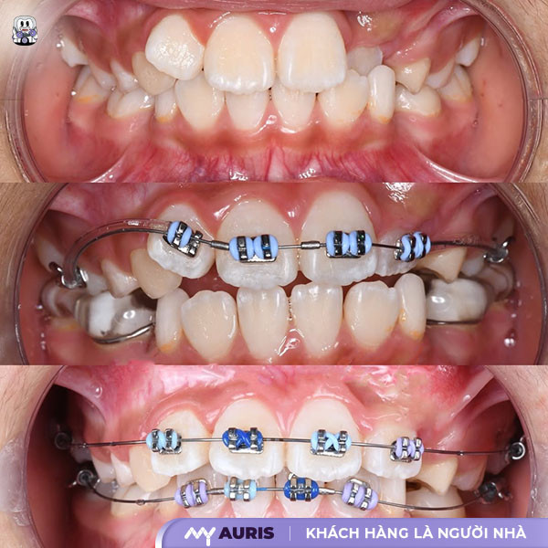 trước và sau khi niềng răng mọc lệch