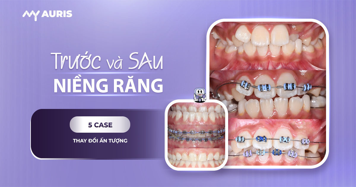 niềng răng trước và sau,trước và sau khi niềng răng