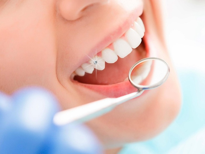 Bảng giá răng bọc sứ