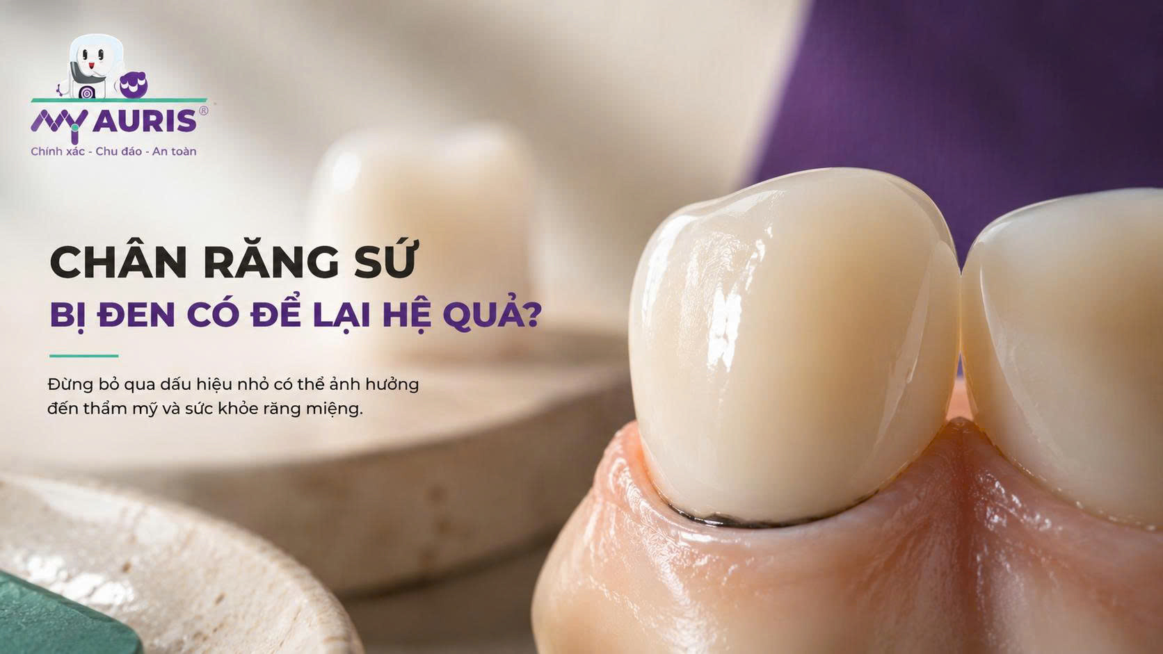Chân răng sứ bị đen có để lại hệ quả Chân răng sứ bị đen có để lại hệ quả